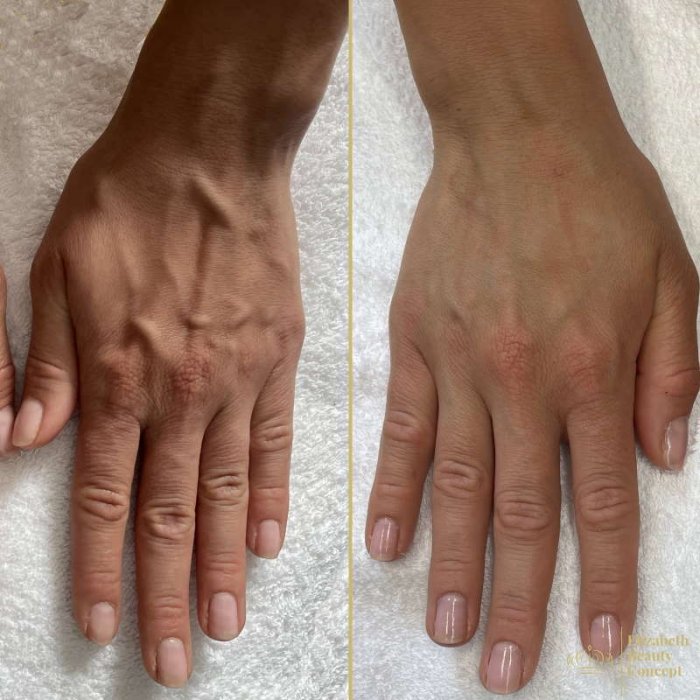 Mezoterapie rukou - před a po fotografie